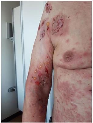 Effect of early initiation of steroid-sparing drugs in patients with bullous pemphigoid